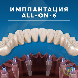 ALL-ON-6