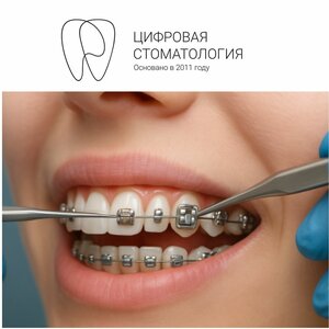 Установка брекет-системы легкой степени сложности (1 чел