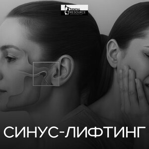 Синус-лифтинг от
