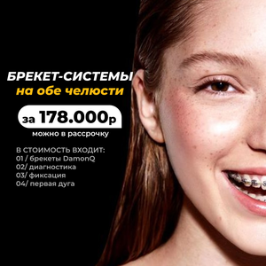Брекет-система на обе челюсти 