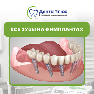 Все зубы на 6 имплантатах (all on 6), диоксид циркония 