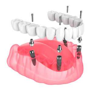 Имплантация всей челюсти по методу All-On-4