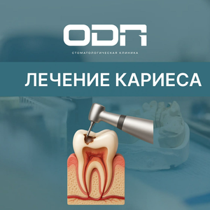 Лечение кариеса от