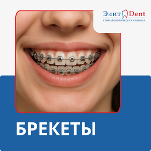 Брекеты от