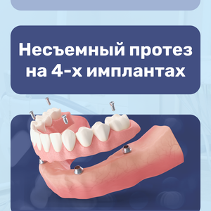 Имплантация ALL-ON-4 под ключ