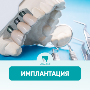 Имплант зуба от