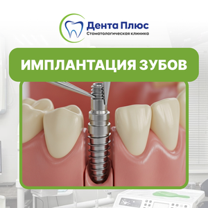 Имплантация Зуба Osstem (Южная Корея)