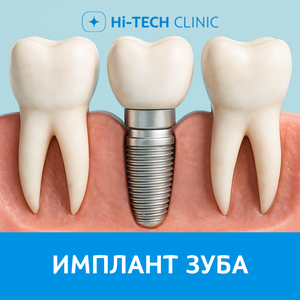 Имплант зуба отх