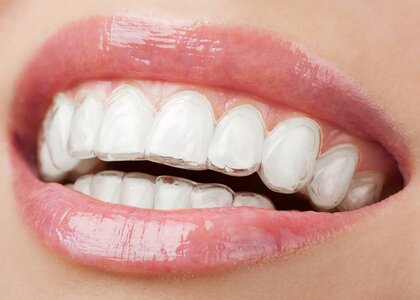 Элайнеры