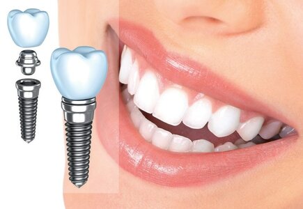 Имплантация зубов Dentium 