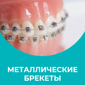 Металлические брекеты