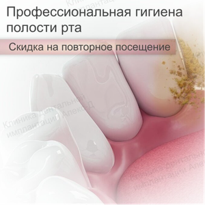 Профессиональная чистка зубов