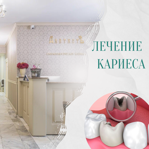 Лечение кариеса