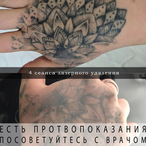 Лазерное удаление татуировок