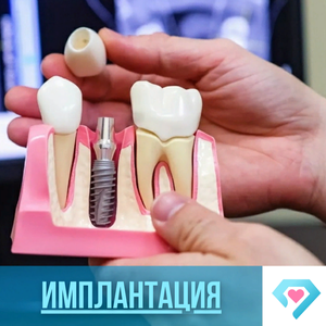 Имплантация зубов под ключ 