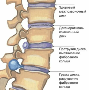 Реконструкция позвоночника