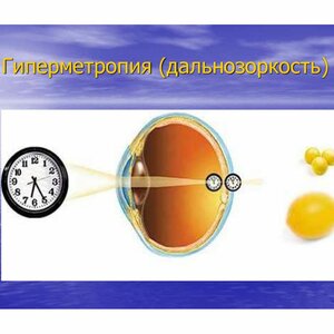 Дальнозоркость (гиперметропия)