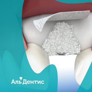 Остеопластики в Тюмени стоматология АльДентис