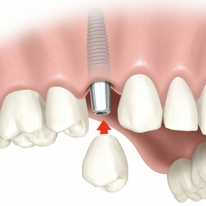 Имплантация зубов Dentium 