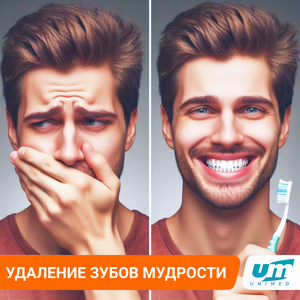 Удаление зубов мудрости, ретинированных восьмерок.