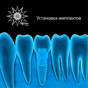 Имплантация зубов в Тюмени