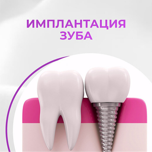 Имплантация зубов