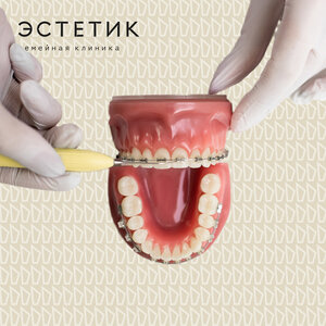 Установка брекет-системы