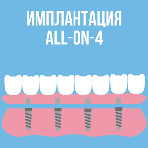 Имплантация зубов All-on-4