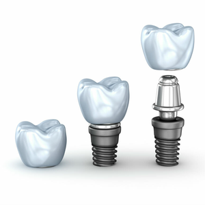 Установка импланта Dentium