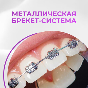 Брекеты: недорогая установка всех типов брекет-систем