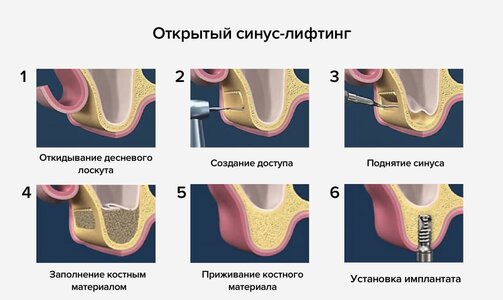 Удаление зуба