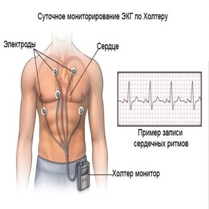 Суточное холтеровское мониторирование ЭКГ