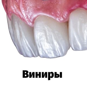 Виниры