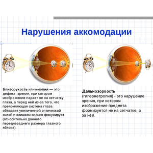 Нарушения аккомодации