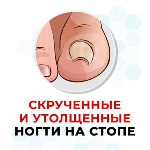 Скрученные и утолщённые ногти на стопе