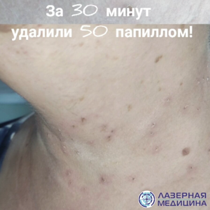 Удаление папиллом на теле