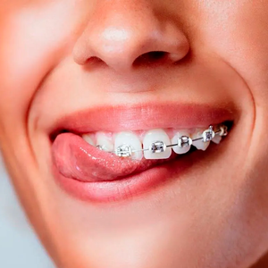 Брекет система Mini Diamand