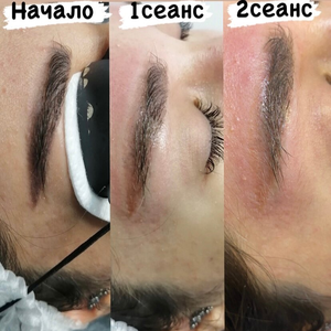 Удаление перманента и татуажа 