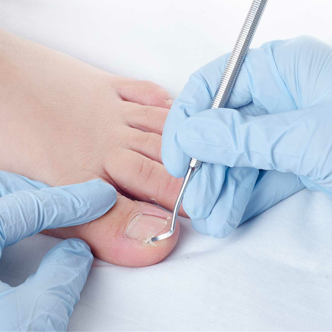Как выглядит вросший ноготь на ноге фото Kabinet podologii i professional'nogo pedikjura, nail studio, Иркутск, улица Сте