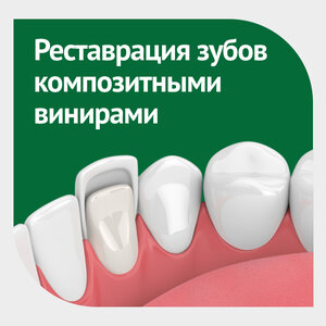 Реставрация зубов композитными винирами под ключ