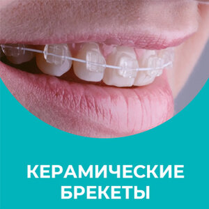 Керамические брекеты