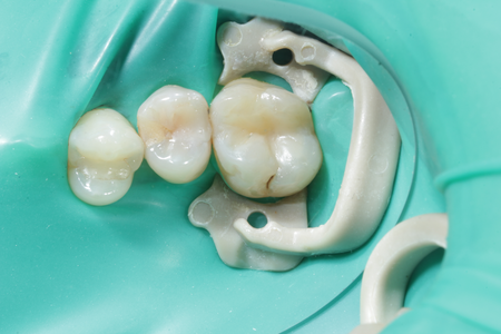 Лечение кариеса
