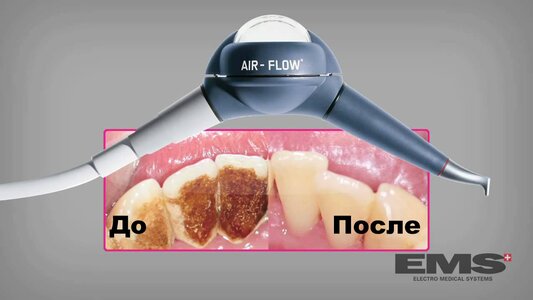 Профессиональная гигиена методом AIR-FLOW - комплекс