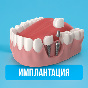 Имплантация