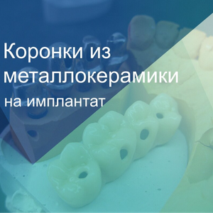 Металлокерамика на имплантат