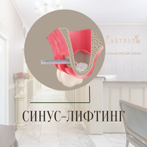 Синуслифтинг, закрытый 