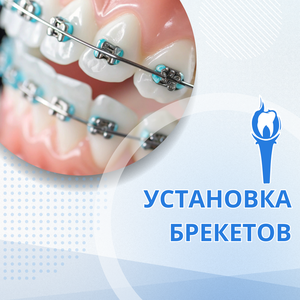 Установка брекетов