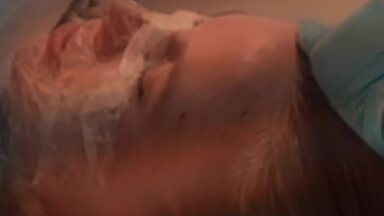 Биоревитализация