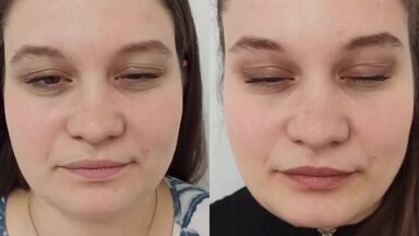 Ботокс в лоб, межбровка, глаза
