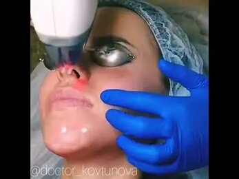 Фракционный фототермолиз на аппарате Fraxel